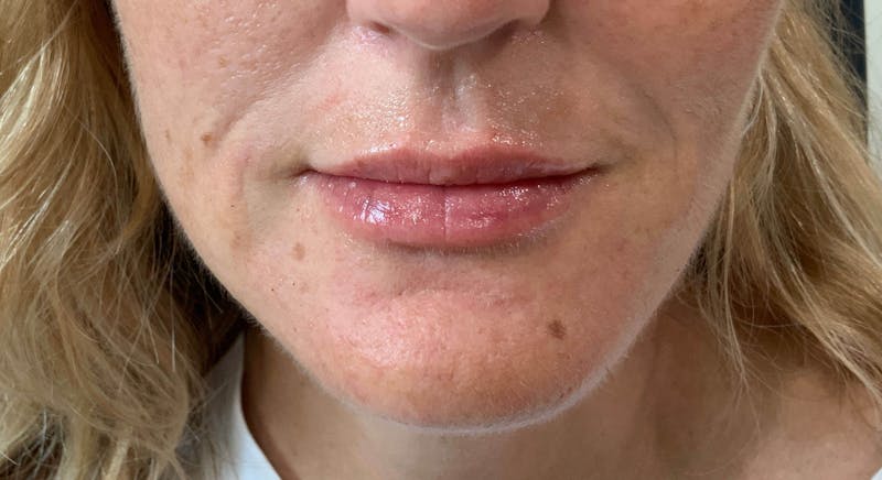 Kimberly Saffman, APRN Before & After Gallery - Patient 764598 - Image 2
