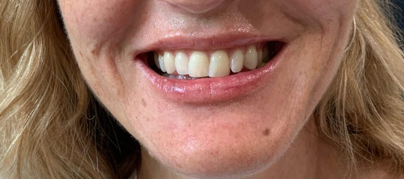 Kimberly Saffman, APRN Before & After Gallery - Patient 764598 - Image 4