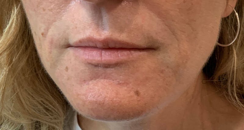 Kimberly Saffman, APRN Before & After Gallery - Patient 764598 - Image 5