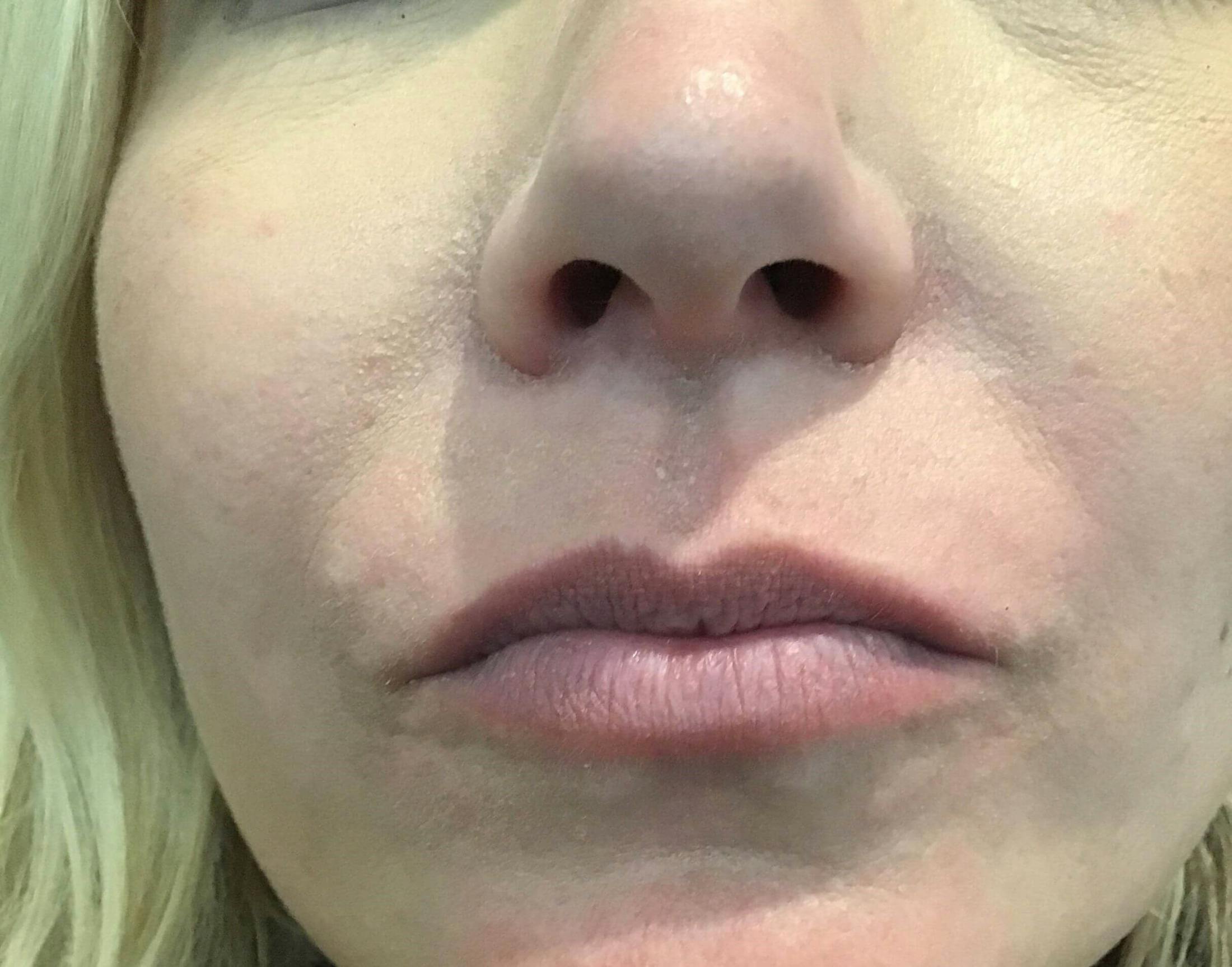 Amy Kadlubowski, APRN Before & After Gallery - Patient 303759 - Image 1