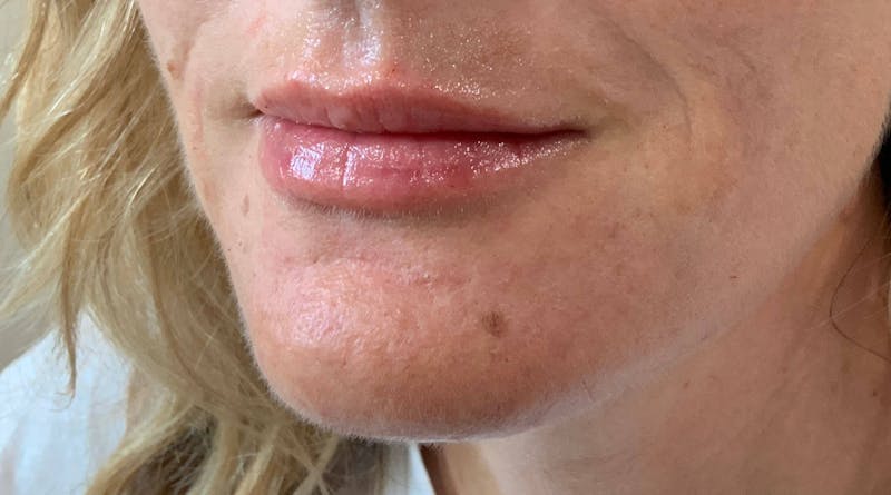 Kimberly Saffman, APRN Before & After Gallery - Patient 764598 - Image 6
