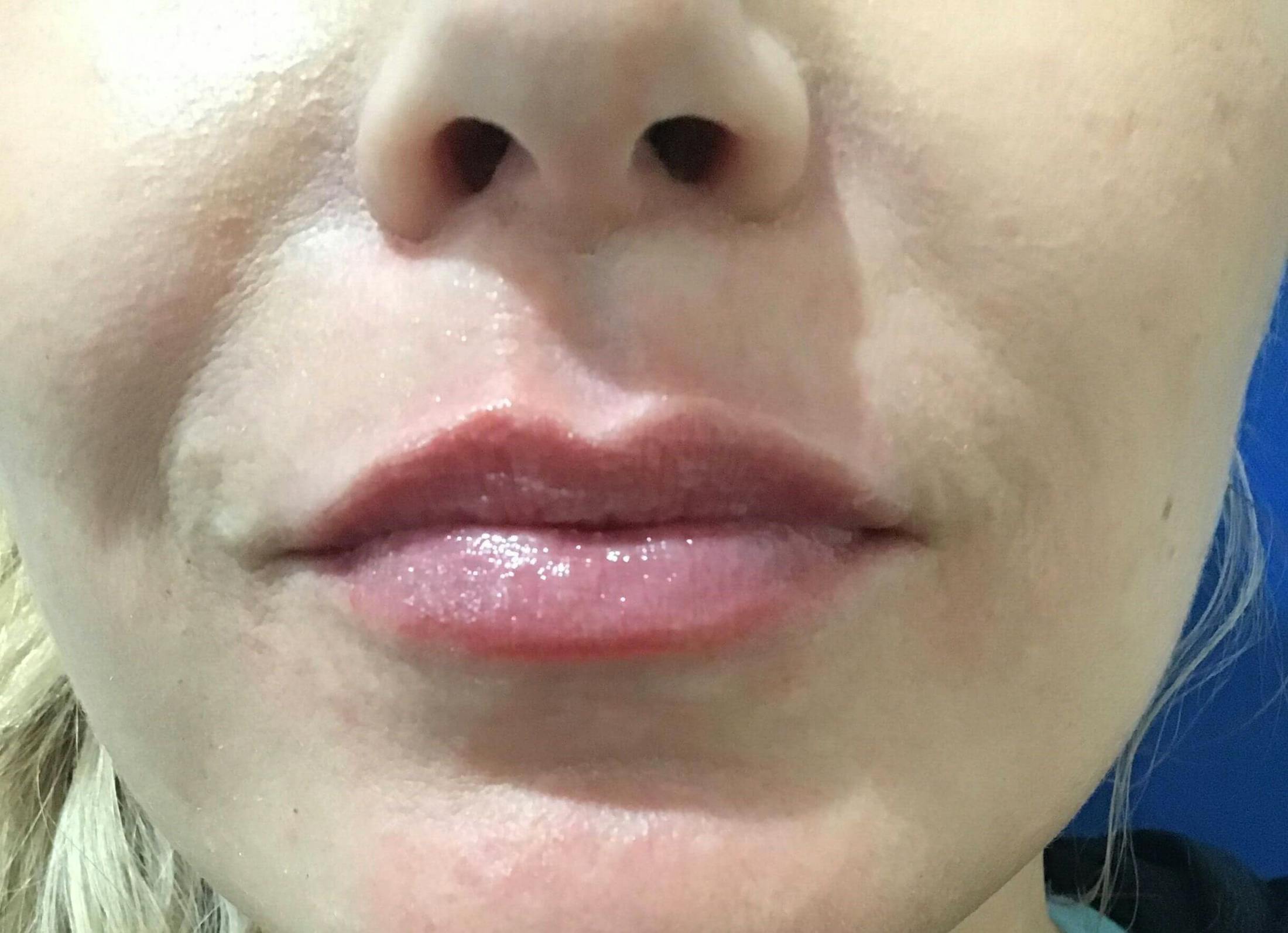 Amy Kadlubowski, APRN Before & After Gallery - Patient 303759 - Image 2