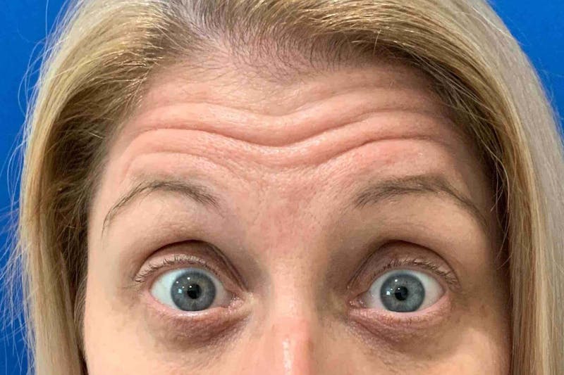 Sharon Prince, APRN Before & After Gallery - Patient 174320 - Image 1