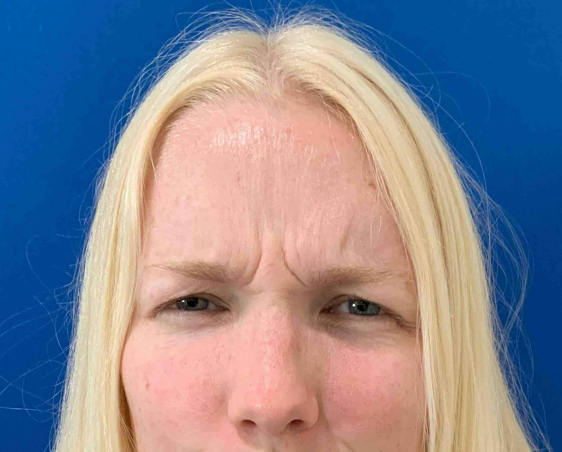 Sharon Prince, APRN Before & After Gallery - Patient 260886 - Image 1