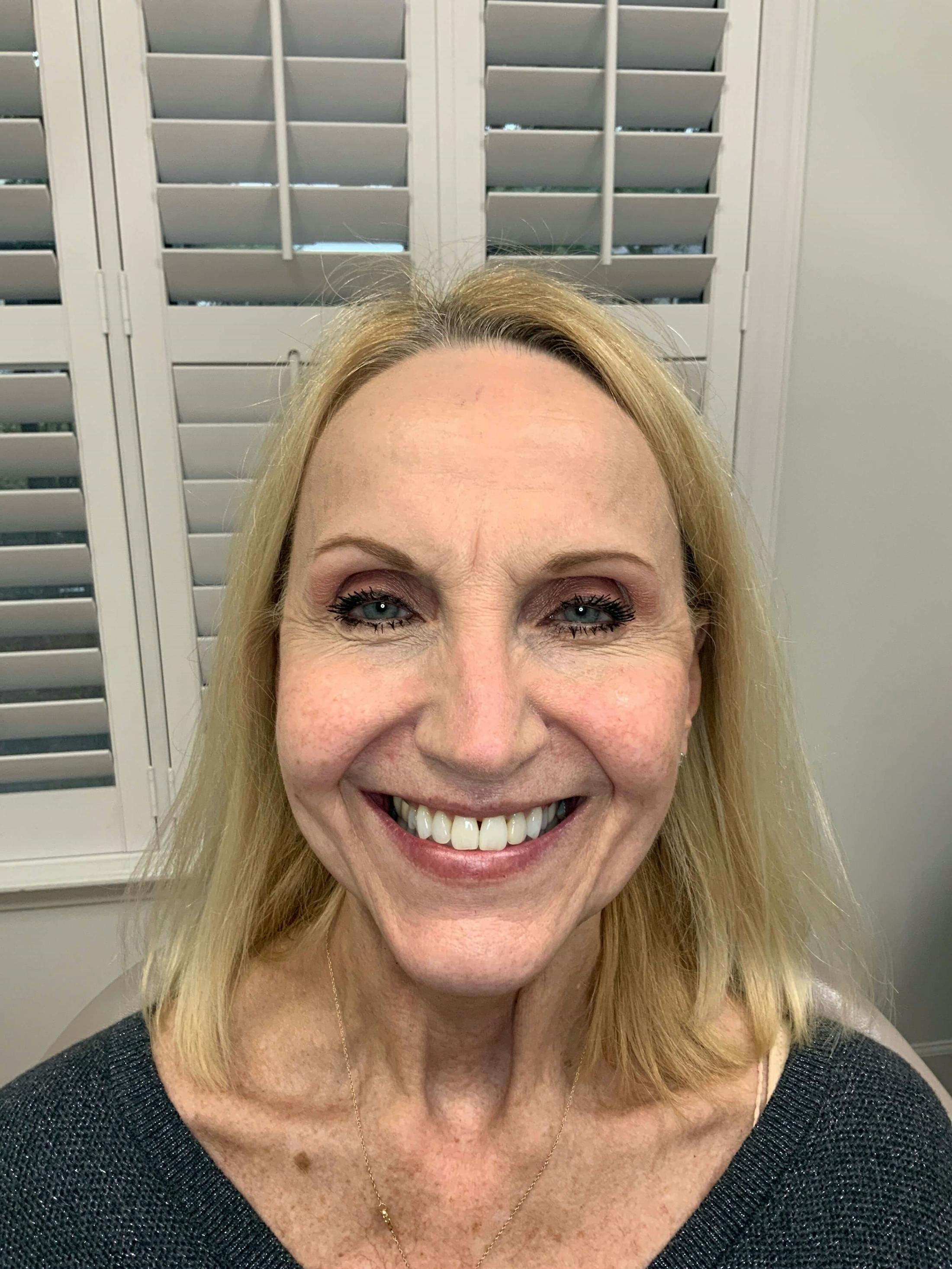 Sharon Prince, APRN Before & After Gallery - Patient 466944 - Image 1