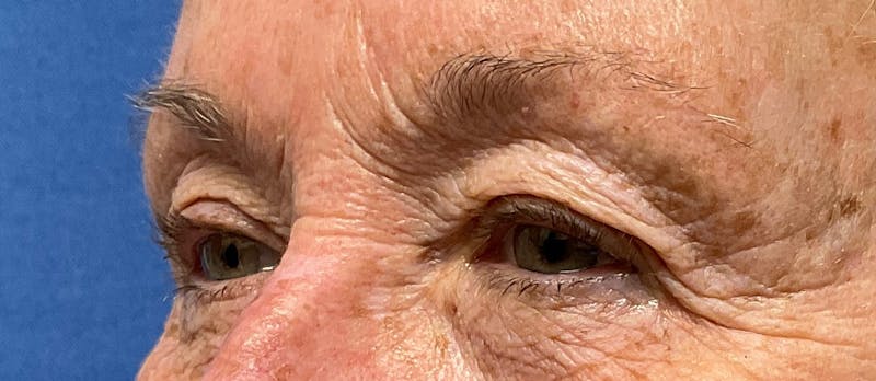 Dr. Chris Bates Before & After Gallery - Patient 107151 - Image 6