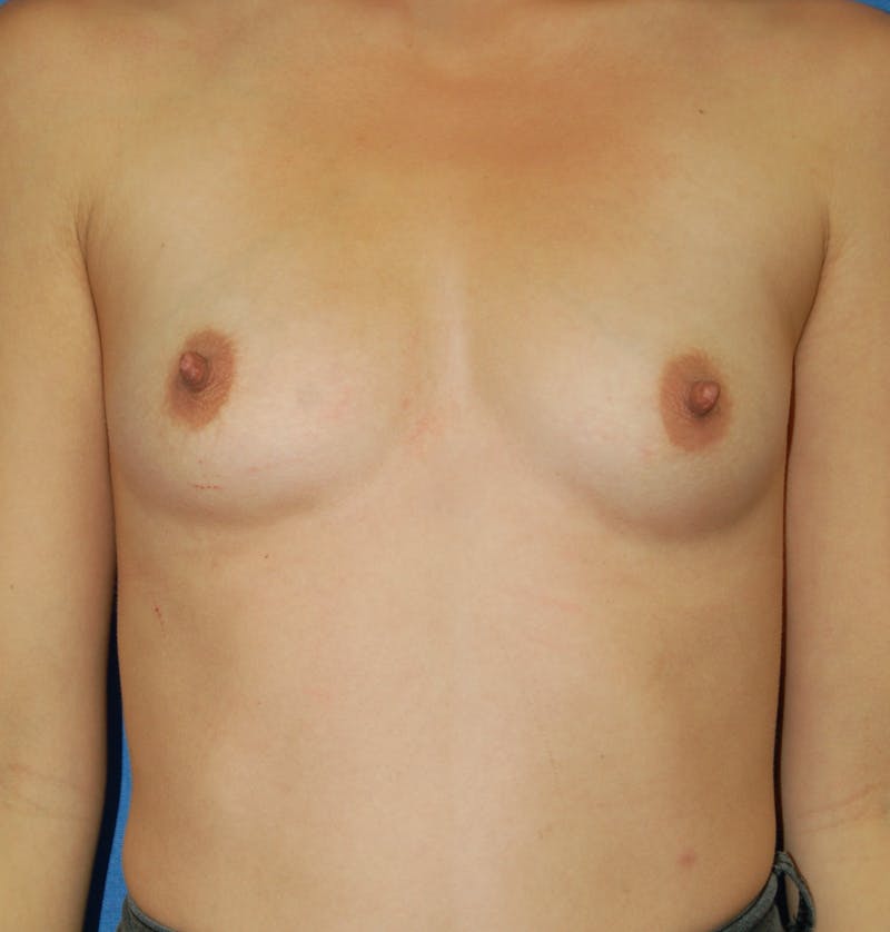 Dr. Robert Burk Before & After Gallery - Patient 971651 - Image 1