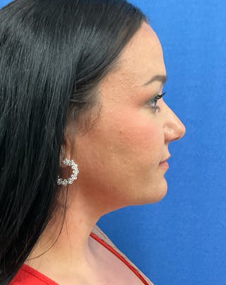 Dr. Ellen Hancock Before & After Gallery - Patient 237281 - Image 2