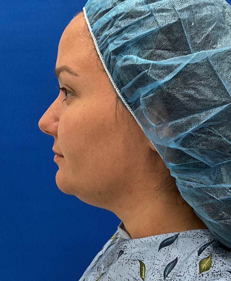 Dr. Ellen Hancock Before & After Gallery - Patient 237281 - Image 3