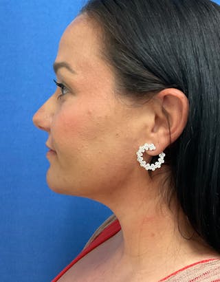 Dr. Ellen Hancock Before & After Gallery - Patient 237281 - Image 4