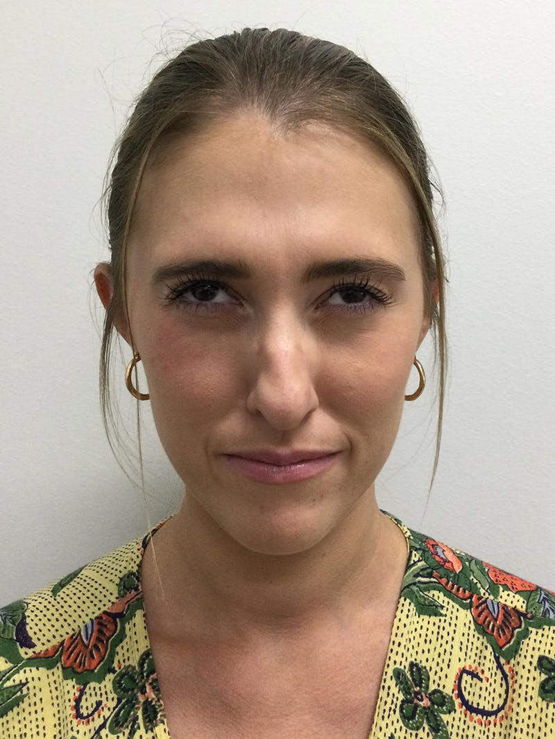 Carrie Cummings, DNP Before & After Gallery - Patient 394305 - Image 6