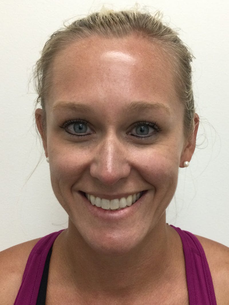 Carrie Cummings, DNP Before & After Gallery - Patient 383978 - Image 4