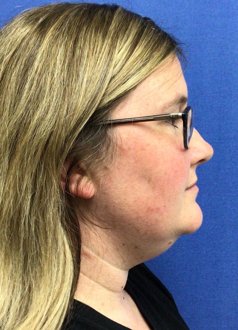 Dr. Chris Bates Before & After Gallery - Patient 142112 - Image 5