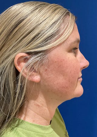 Dr. Chris Bates Before & After Gallery - Patient 142112 - Image 6