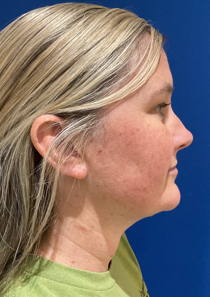 Dr. Chris Bates Before & After Gallery - Patient 142112 - Image 6