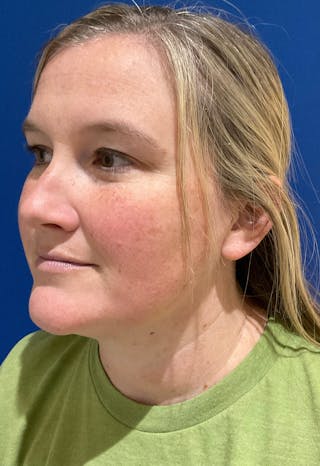 Dr. Chris Bates Before & After Gallery - Patient 142112 - Image 8