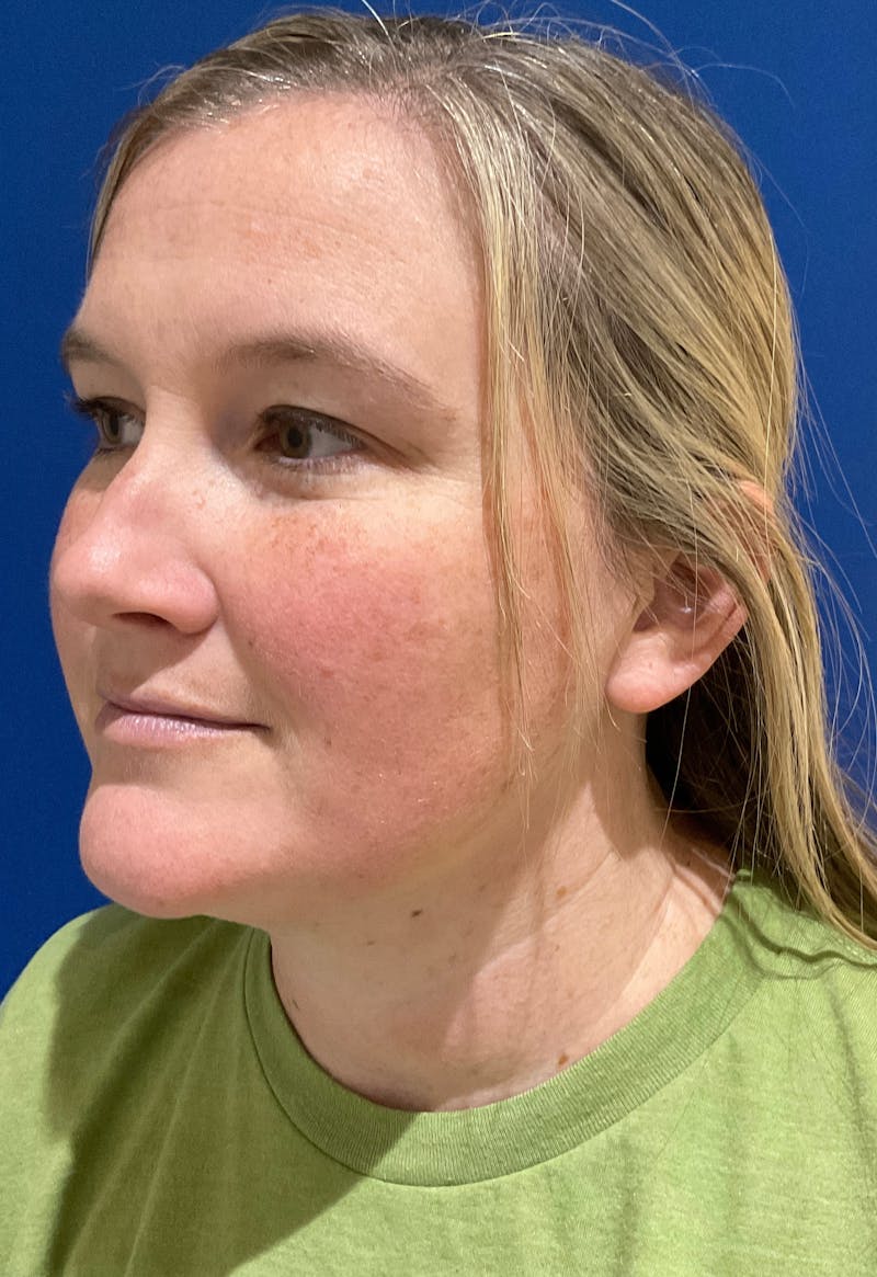 Dr. Chris Bates Before & After Gallery - Patient 142112 - Image 8