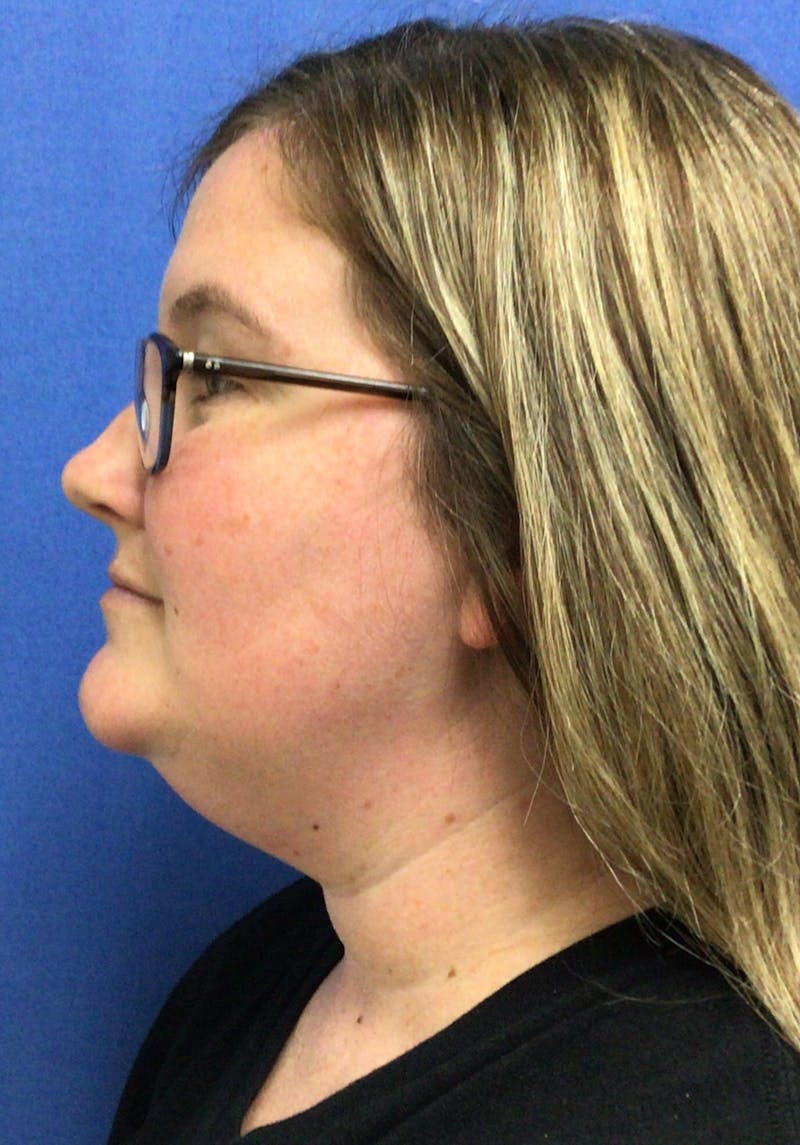 Dr. Chris Bates Before & After Gallery - Patient 142112 - Image 9