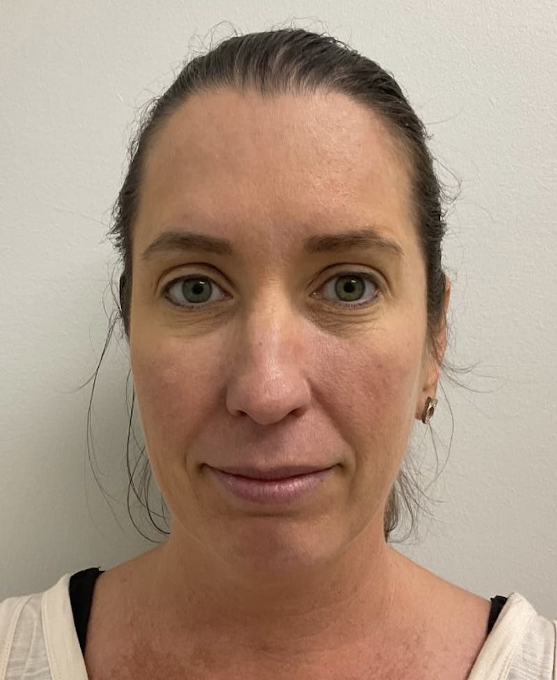 Dr. Chris Bates Before & After Gallery - Patient 224049 - Image 2