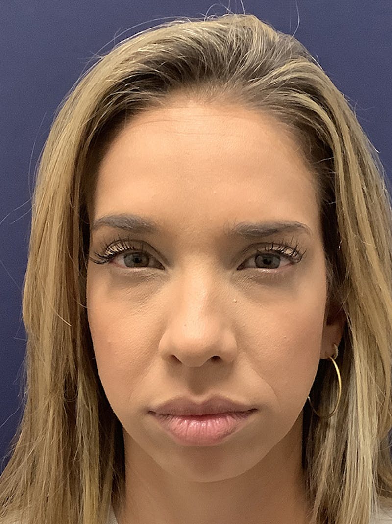 Kellee Murray, DNP Before & After Gallery - Patient 563168 - Image 6