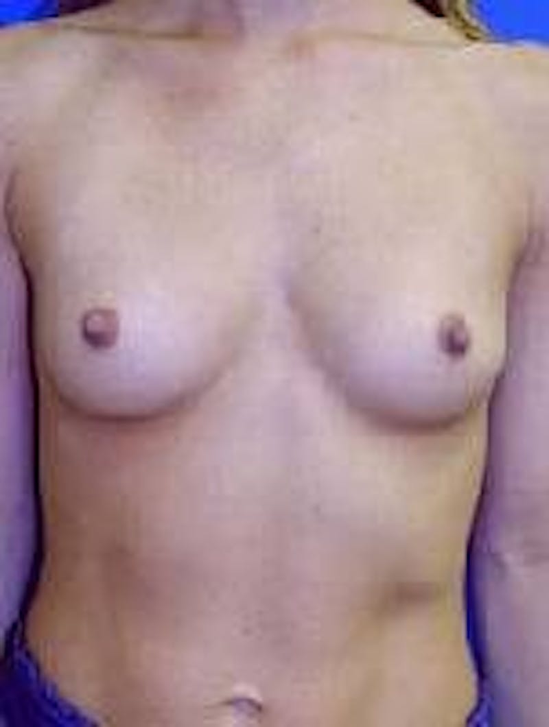 Dr. Robert Burk Before & After Gallery - Patient 287721 - Image 1