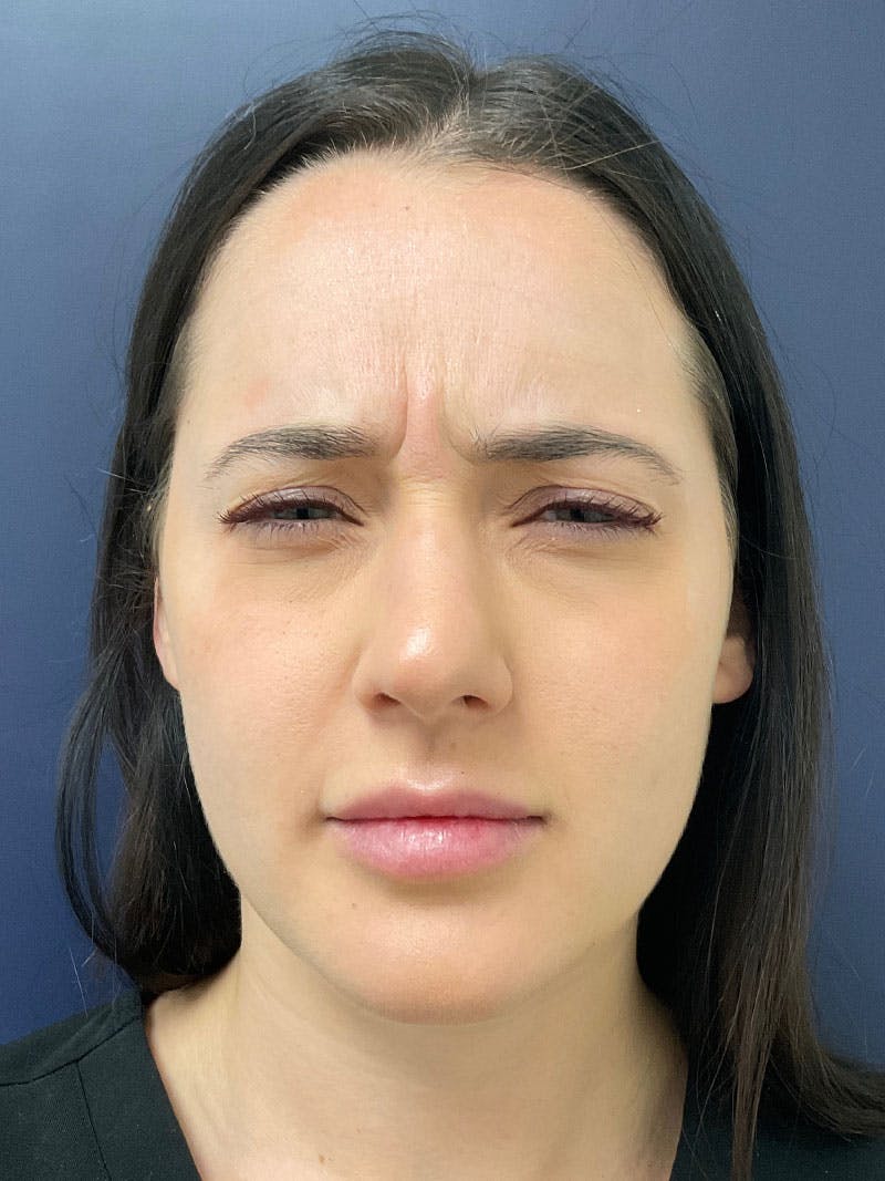Kellee Murray, DNP Before & After Gallery - Patient 209300 - Image 5