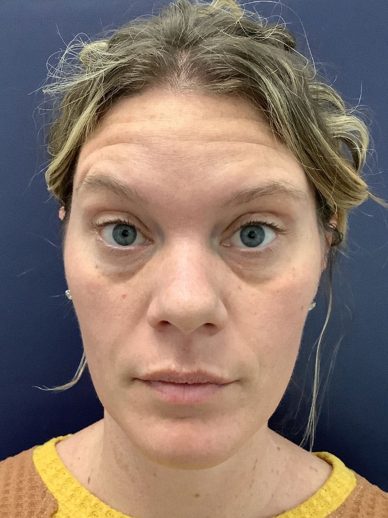 Kellee Murray, DNP Before & After Gallery - Patient 117790 - Image 3