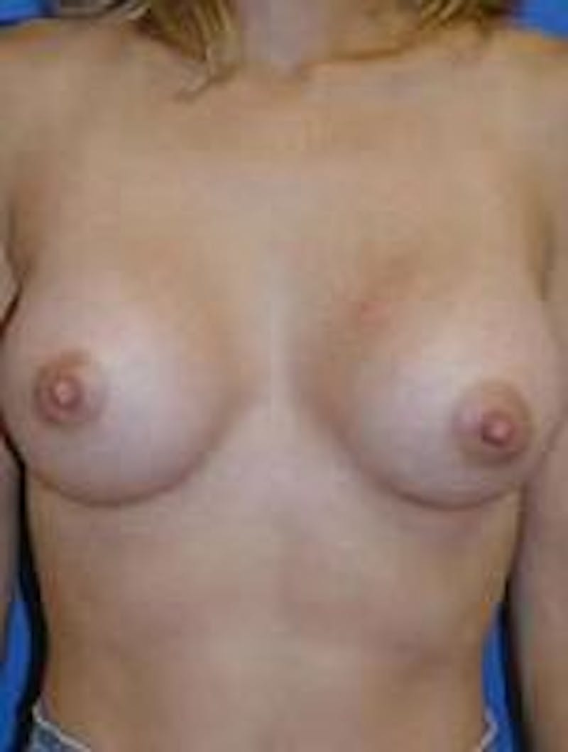 Dr. Robert Burk Before & After Gallery - Patient 580273 - Image 2