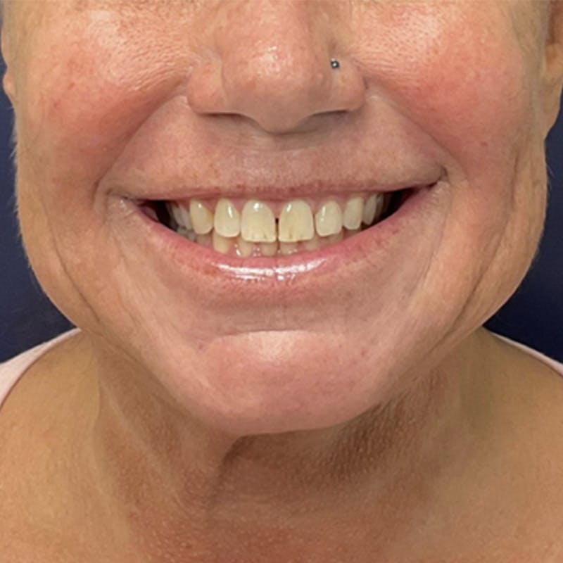 Kellee Murray, DNP Before & After Gallery - Patient 323457 - Image 1