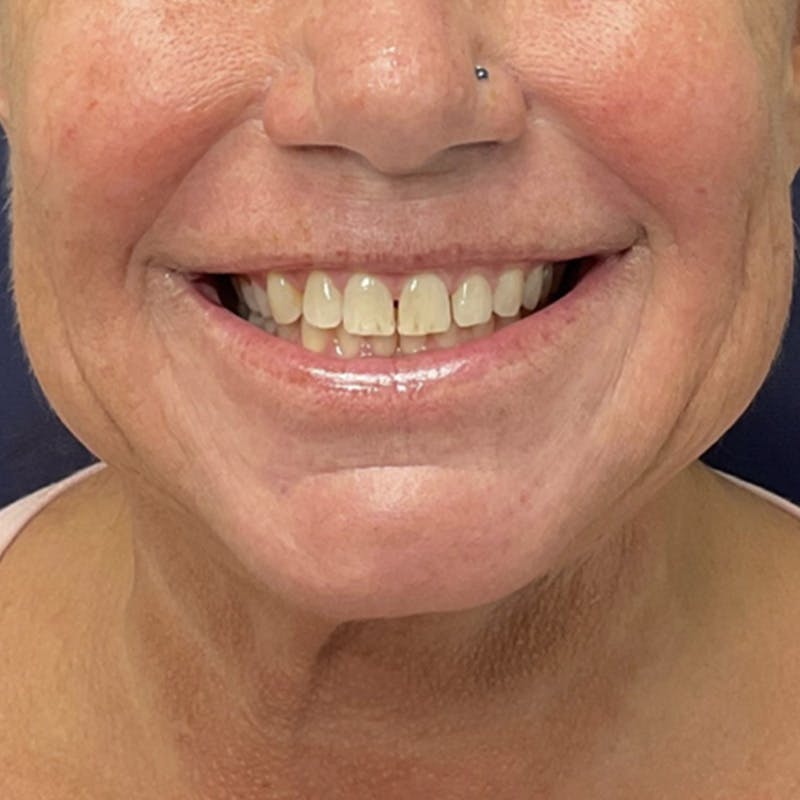 Kellee Murray, DNP Before & After Gallery - Patient 323457 - Image 5