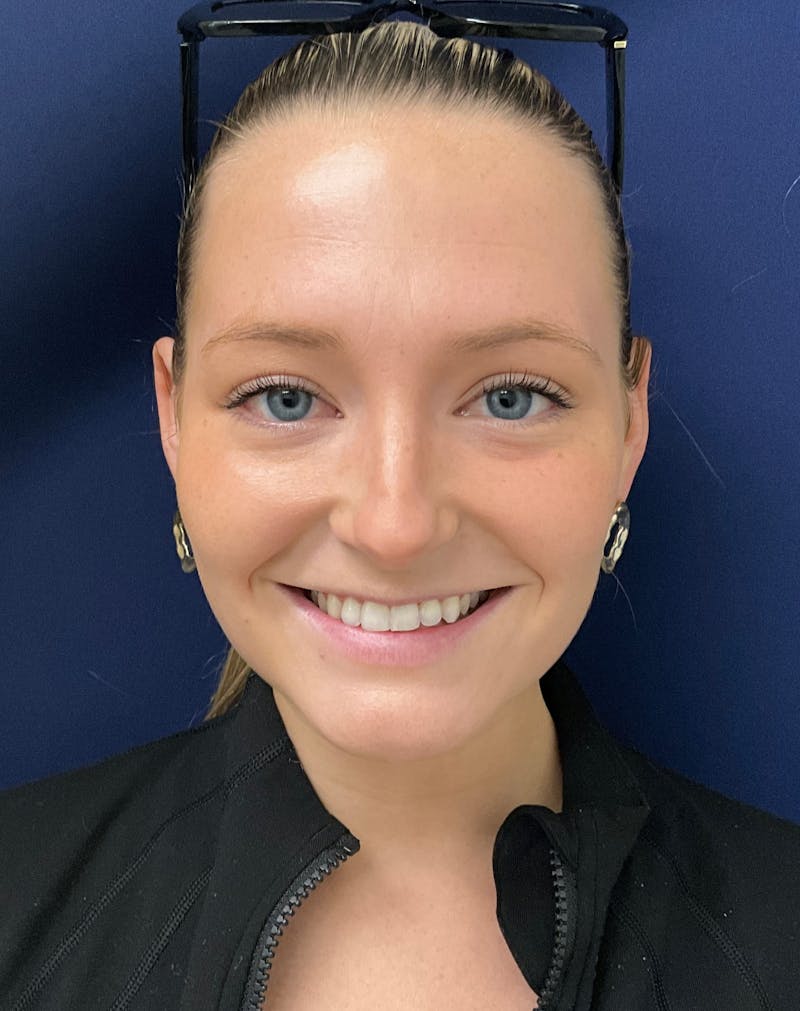 Kristen Dixon, PA-C Before & After Gallery - Patient 722222 - Image 1