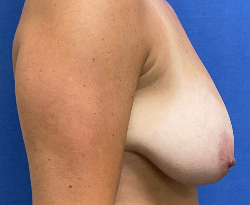 Dr. Chris Bates Before & After Gallery - Patient 655068 - Image 5