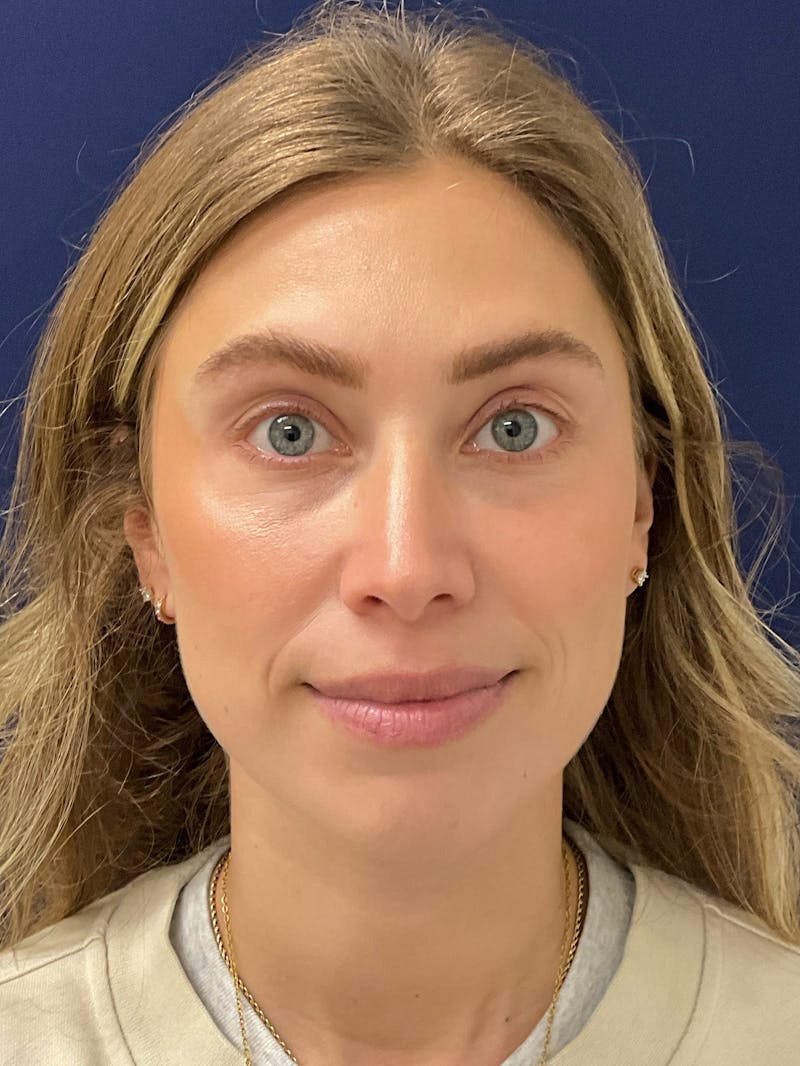 Katelyn Oldenburg, PA-C Before & After Gallery - Patient 265452 - Image 2