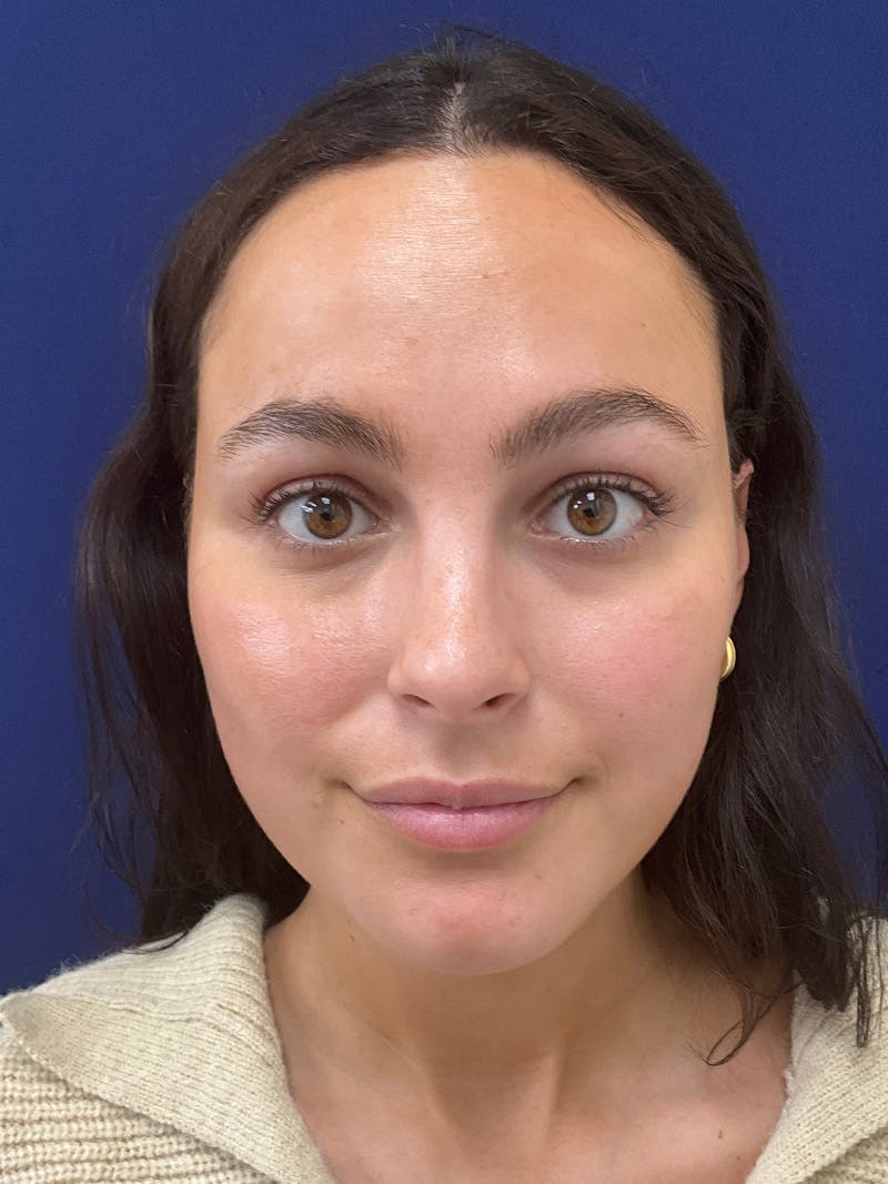 Kristen Dixon, PA-C Before & After Gallery - Patient 193568 - Image 1