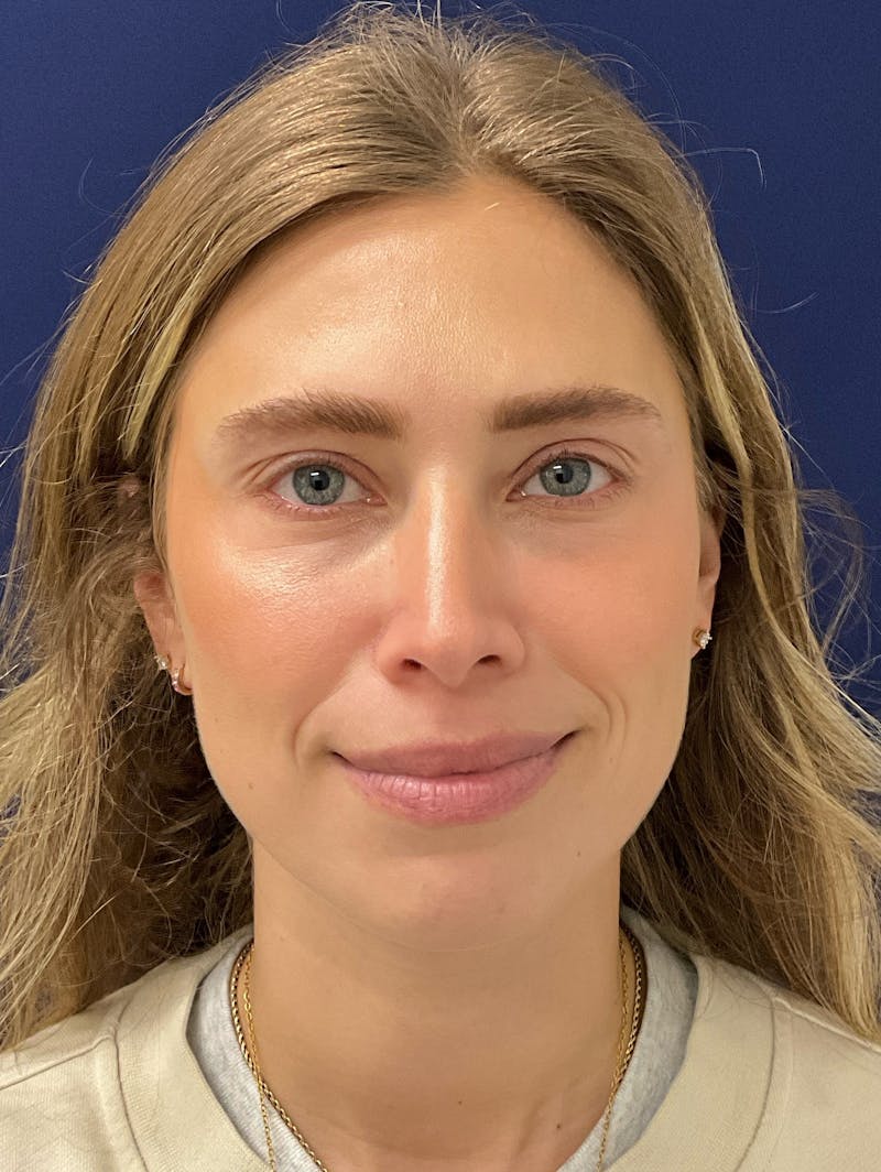 Katelyn Oldenburg, PA-C Before & After Gallery - Patient 265452 - Image 4