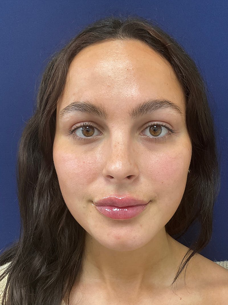 Kristen Dixon, PA-C Before & After Gallery - Patient 193568 - Image 2