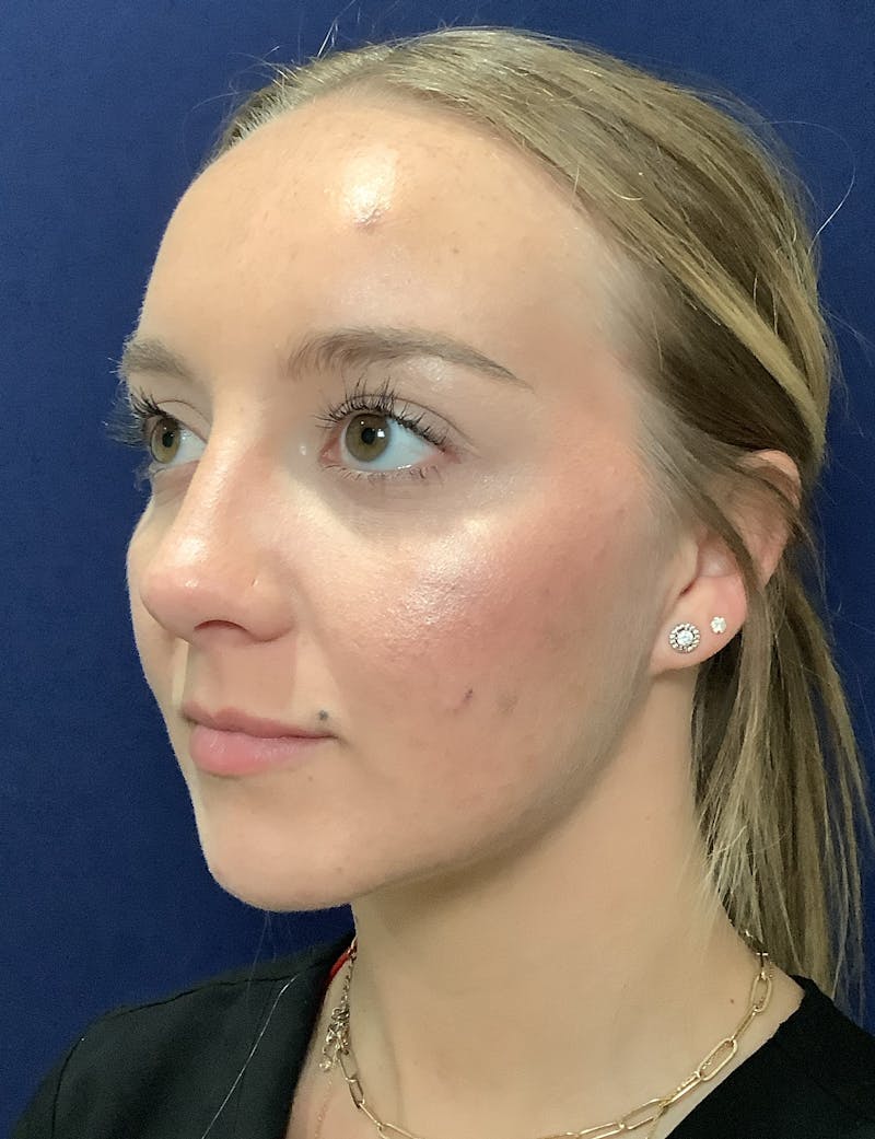 Katelyn Oldenburg, PA-C Before & After Gallery - Patient 176052 - Image 1
