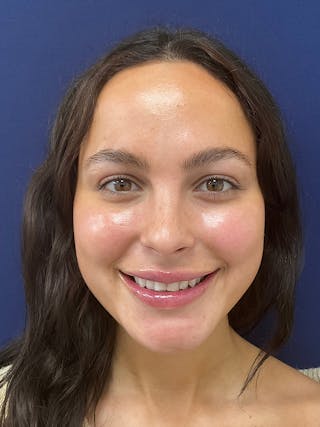 Kristen Dixon, PA-C Before & After Gallery - Patient 193568 - Image 4