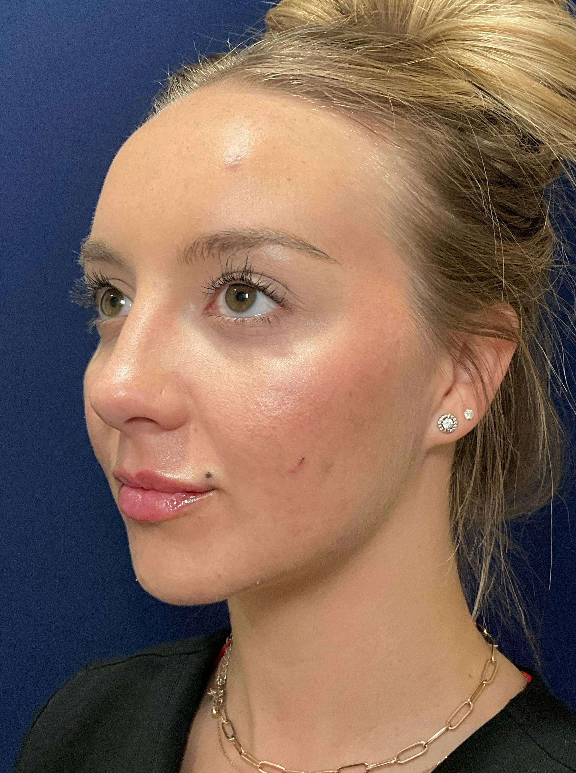 Katelyn Oldenburg, PA-C Before & After Gallery - Patient 176052 - Image 2