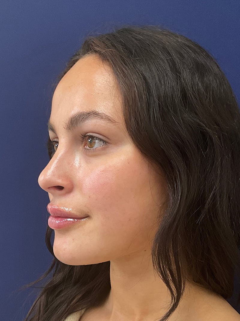 Kristen Dixon, PA-C Before & After Gallery - Patient 193568 - Image 6