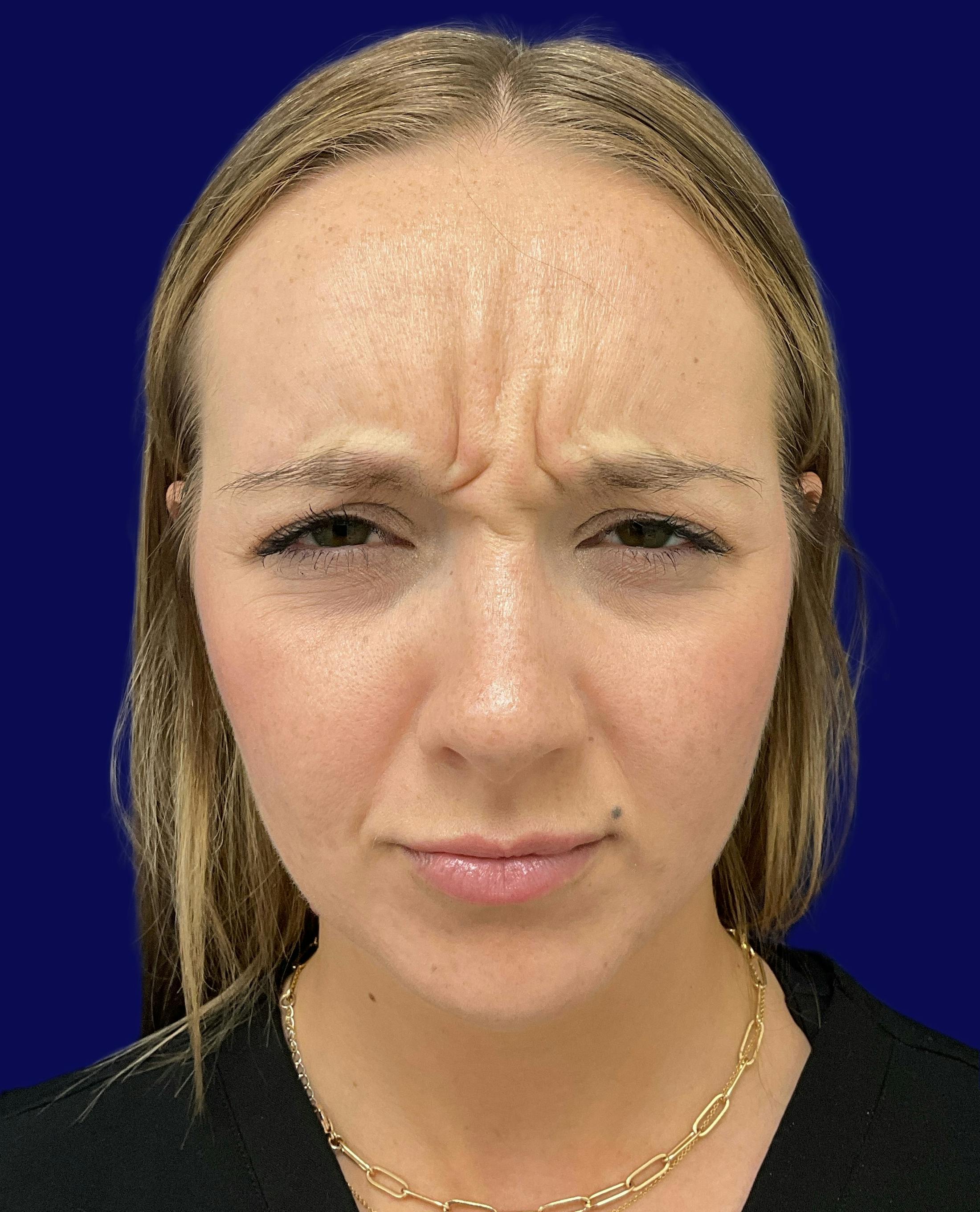 Katelyn Oldenburg, PA-C Before & After Gallery - Patient 305066 - Image 1