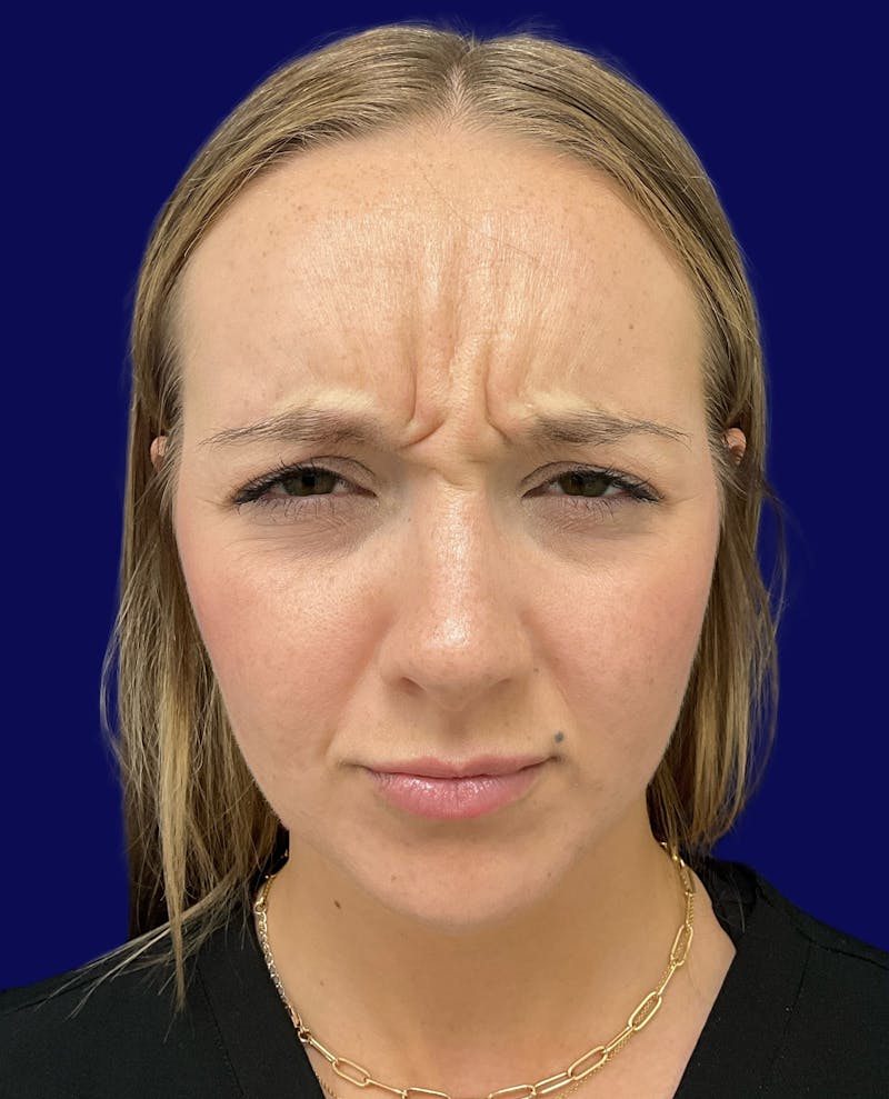 Katelyn Oldenburg, PA-C Before & After Gallery - Patient 305066 - Image 1