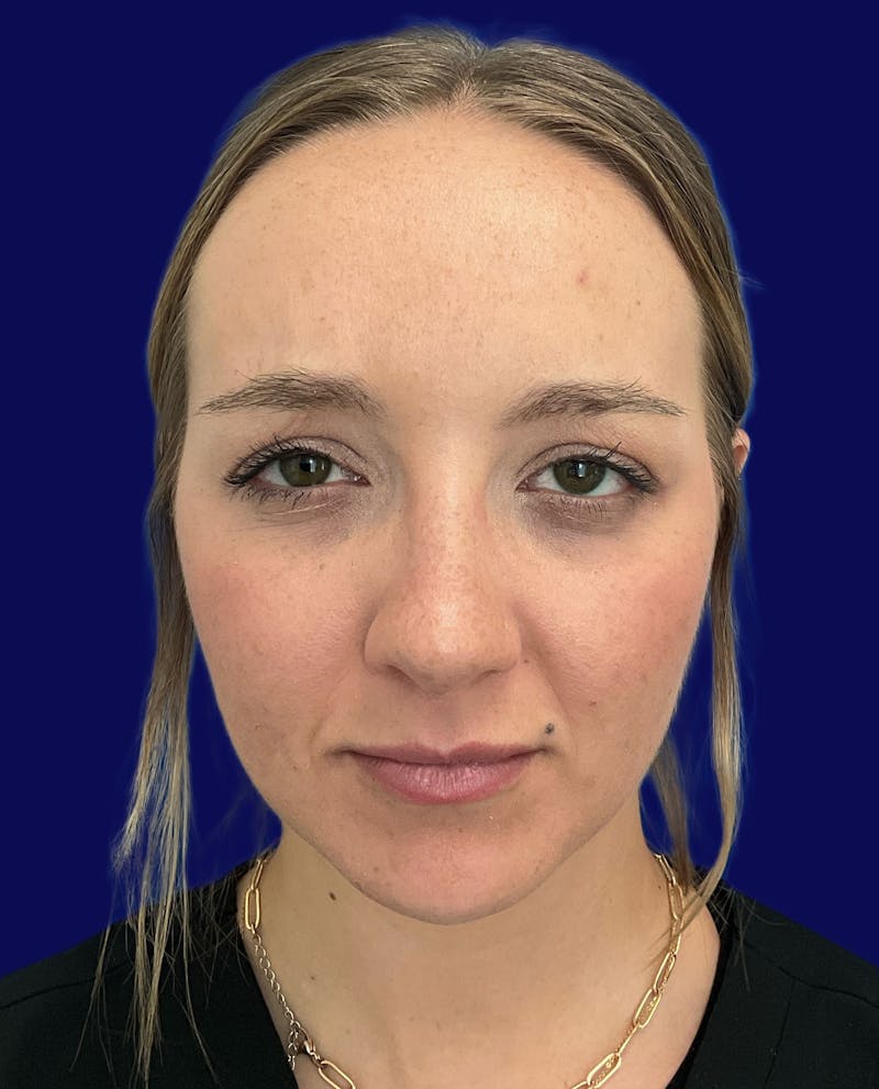 Katelyn Oldenburg, PA-C Before & After Gallery - Patient 305066 - Image 2