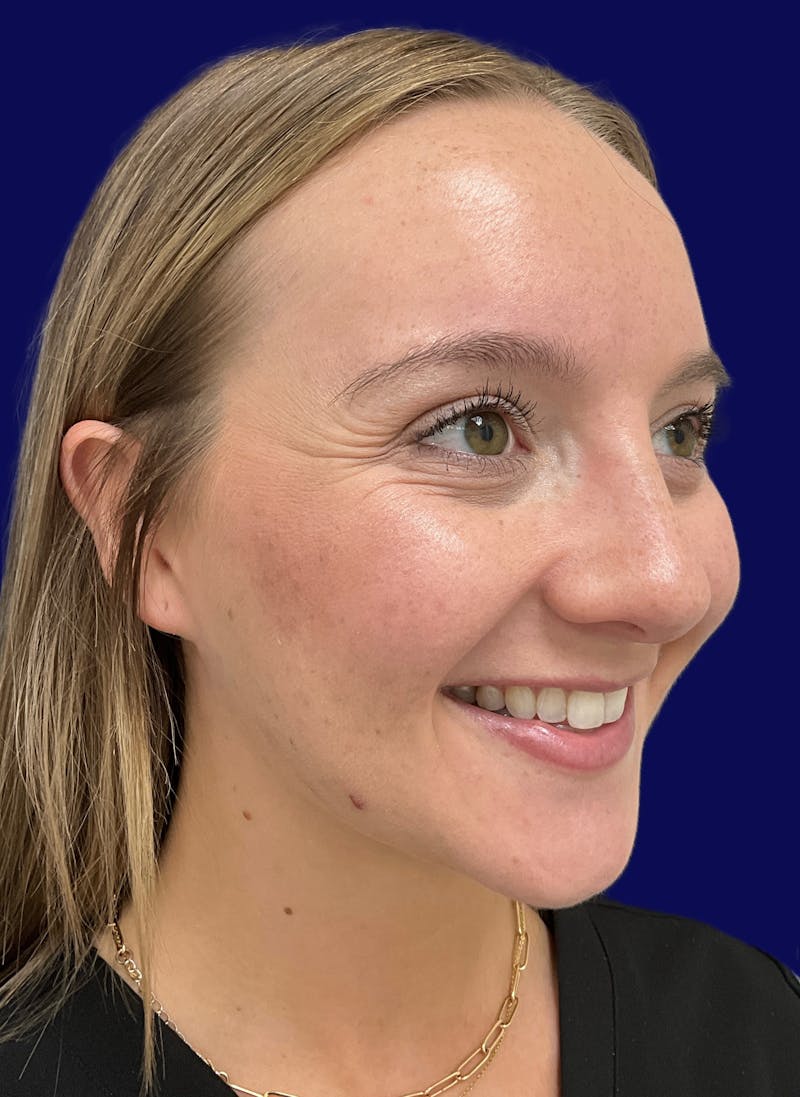 Katelyn Oldenburg, PA-C Before & After Gallery - Patient 305066 - Image 3