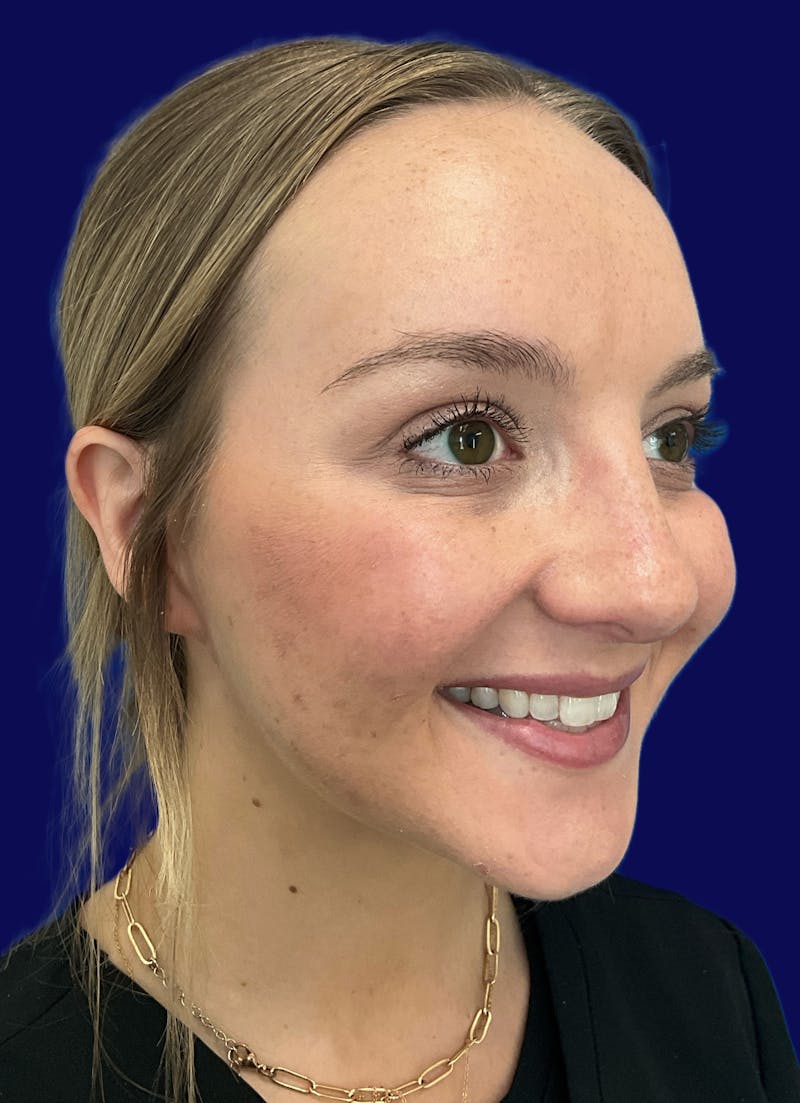 Katelyn Oldenburg, PA-C Before & After Gallery - Patient 305066 - Image 4