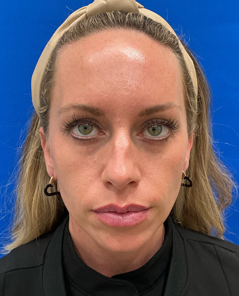 Katelyn Oldenburg, PA-C Before & After Gallery - Patient 970550 - Image 1