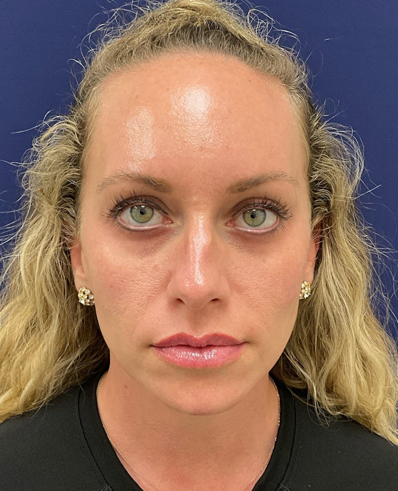 Katelyn Oldenburg, PA-C Before & After Gallery - Patient 970550 - Image 2