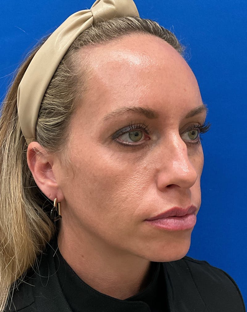 Katelyn Oldenburg, PA-C Before & After Gallery - Patient 970550 - Image 3
