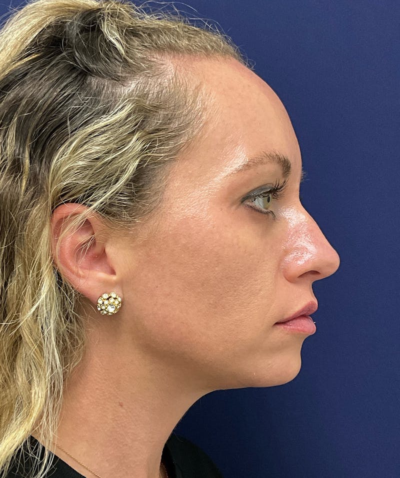 Katelyn Oldenburg, PA-C Before & After Gallery - Patient 970550 - Image 6