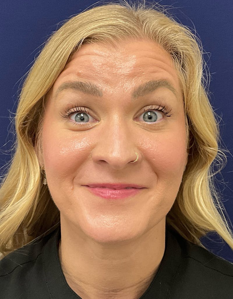 Katelyn Oldenburg, PA-C Before & After Gallery - Patient 169353 - Image 1